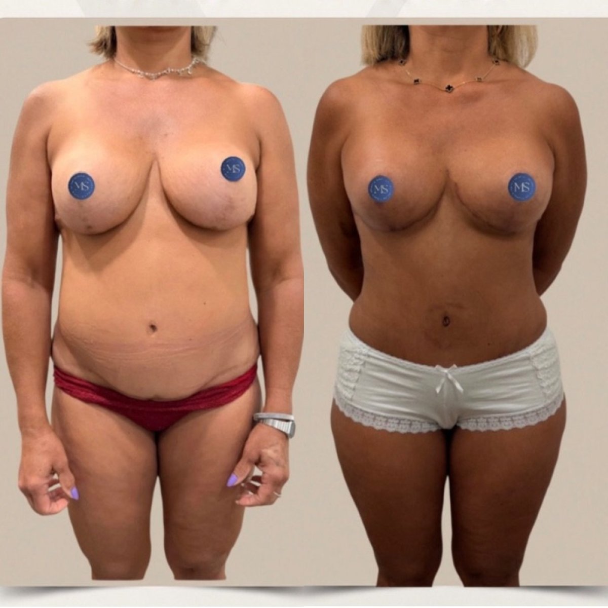نتائج قبل وبعد عملية تجميل الأم في Dr. Michel Salameh - Plastic And Aesthetic Surgery