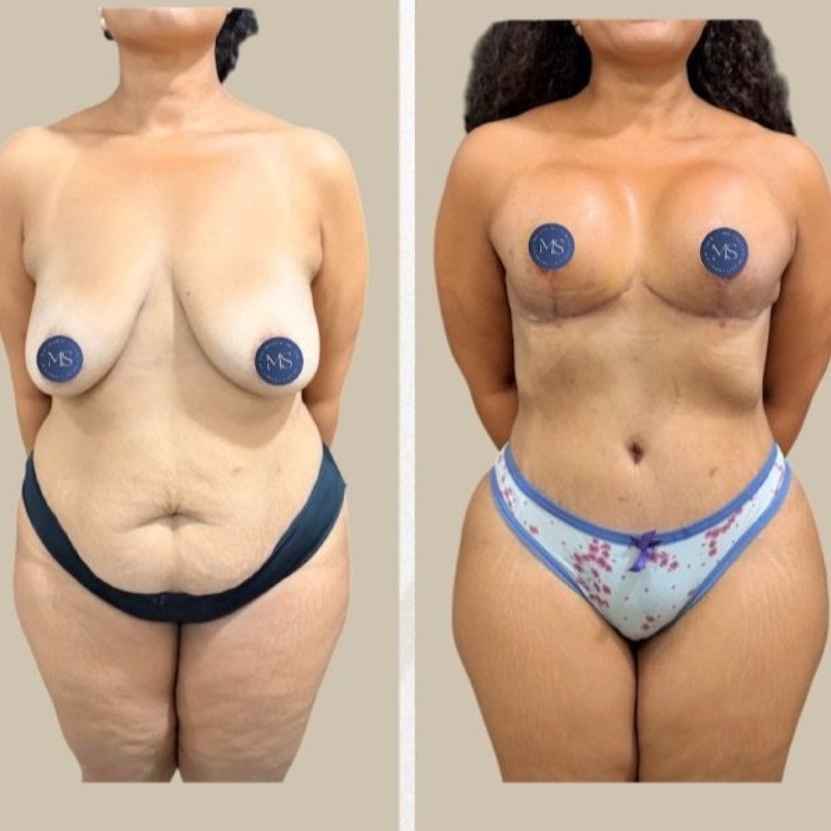 Resultados antes y después de mommy makeover en Dr. Michel Salameh - Plastic And Aesthetic Surgery