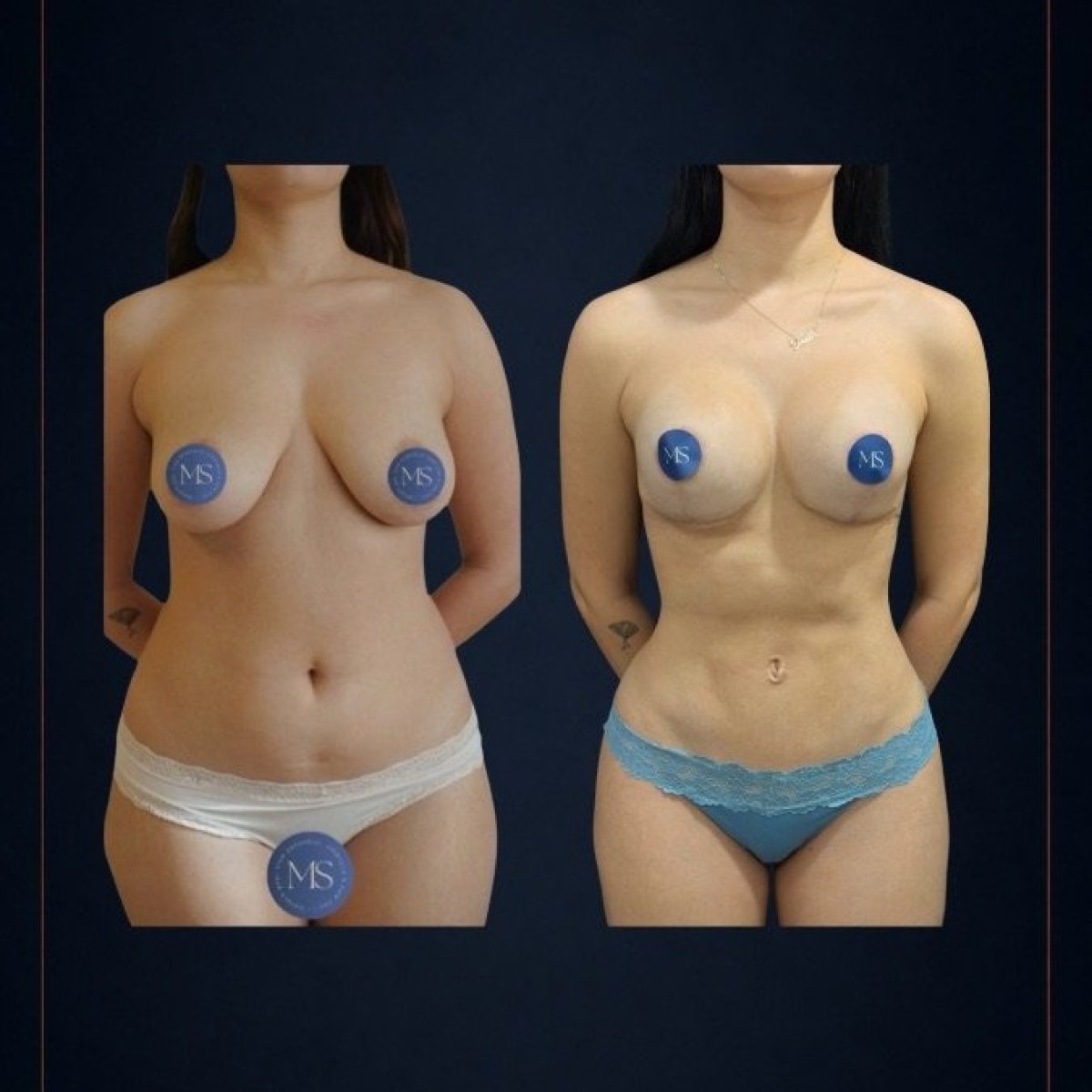 Before and after liposculpture results at Dr. Michel Salameh - Plastic And Aesthetic Surgery