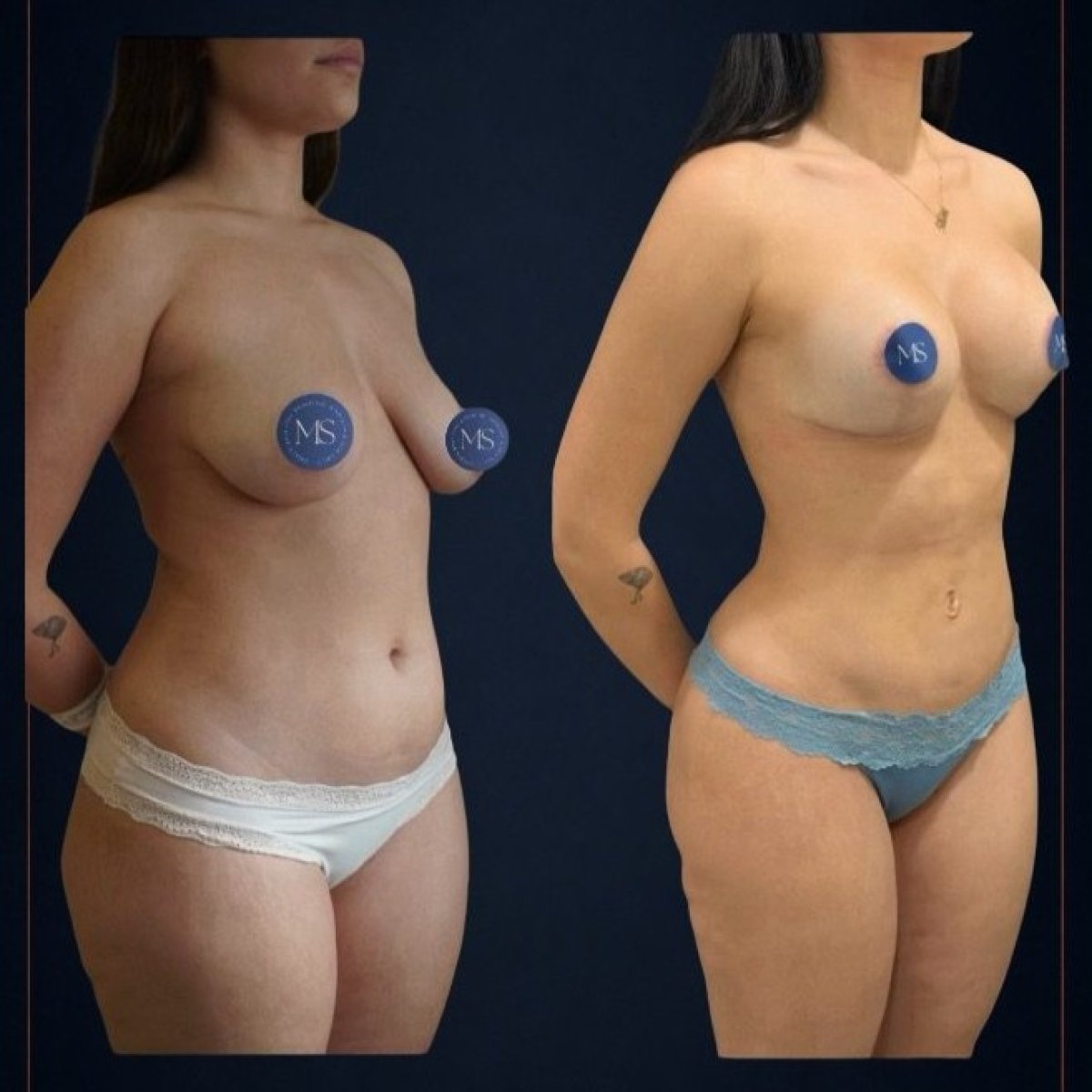 Before and after liposculpture results at Dr. Michel Salameh - Plastic And Aesthetic Surgery