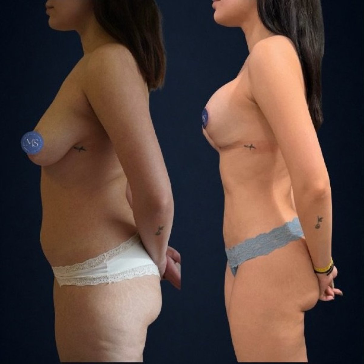 Результаты липоскульптуры до и после в Dr. Michel Salameh - Plastic And Aesthetic Surgery