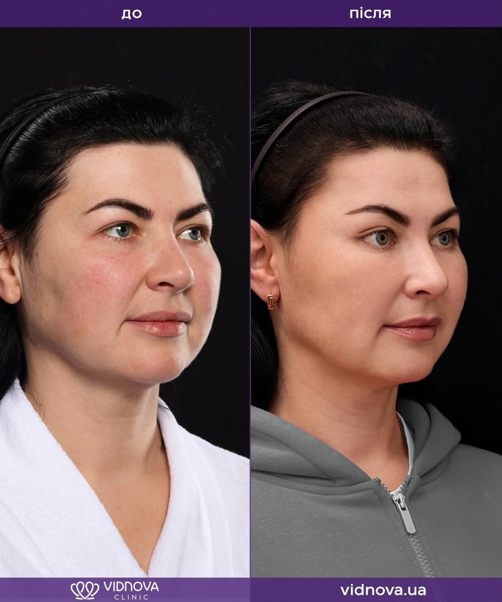 Résultats avant/après lifting deep plane au Vidnova Clinic – rajeunissement facial visible