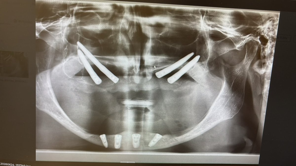 Zygomatic implant result X-ray at Soraca Med showing upper jaw dental implant placement