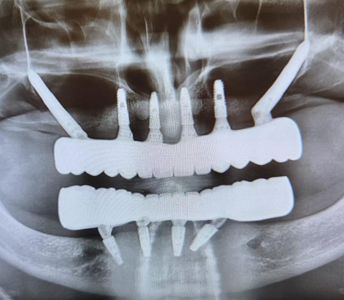 Zygomatic dental implant result at Soraca Med, X-ray showing full arch restoration