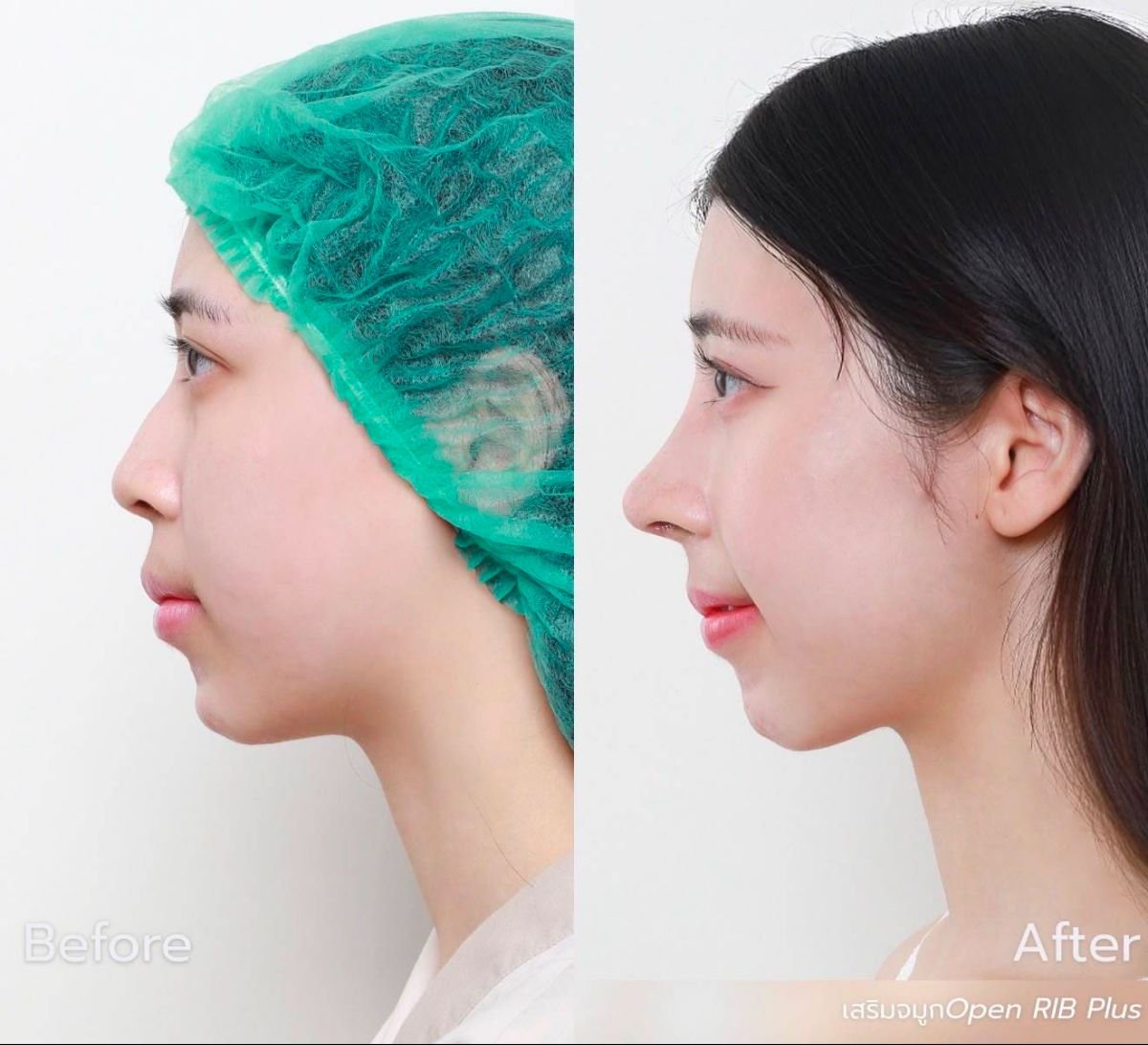 Résultat avant et après rhinoplastie à DGB Clinic, profil nasal et harmonie du visage améliorés