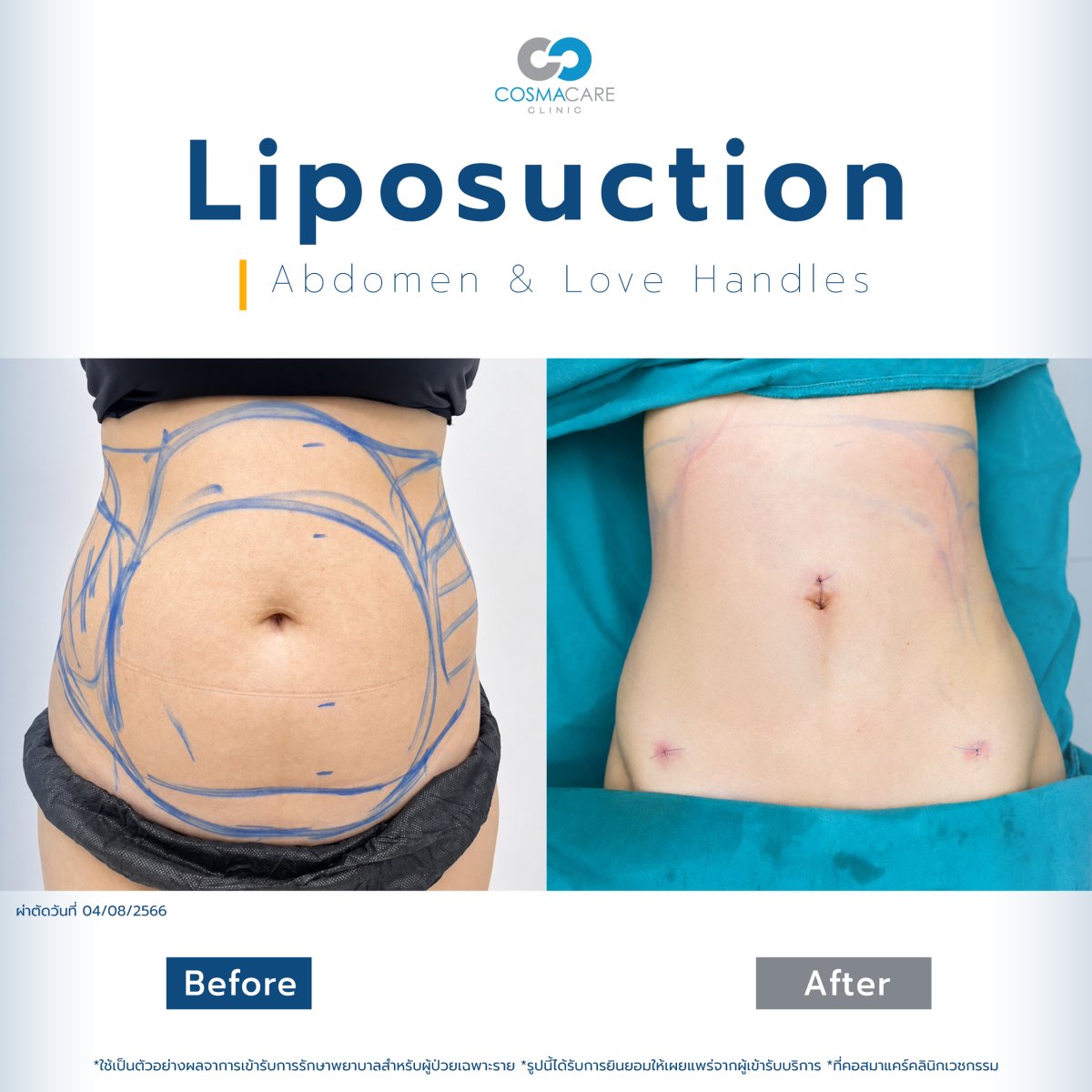 Before and after liposuction results for abdomen and love handles at Cosmacare Clinic Center