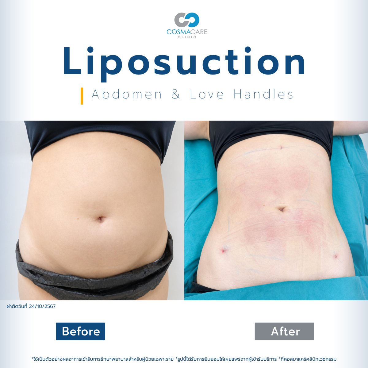 Before and after liposuction results for abdomen and love handles at Cosmacare Clinic Center