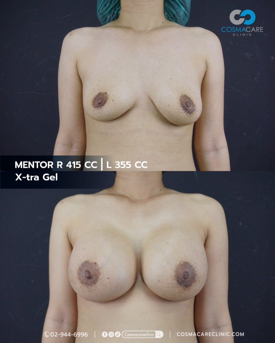Before and after breast augmentation result at Cosmacare Clinic with Mentor X-tra Gel implants
