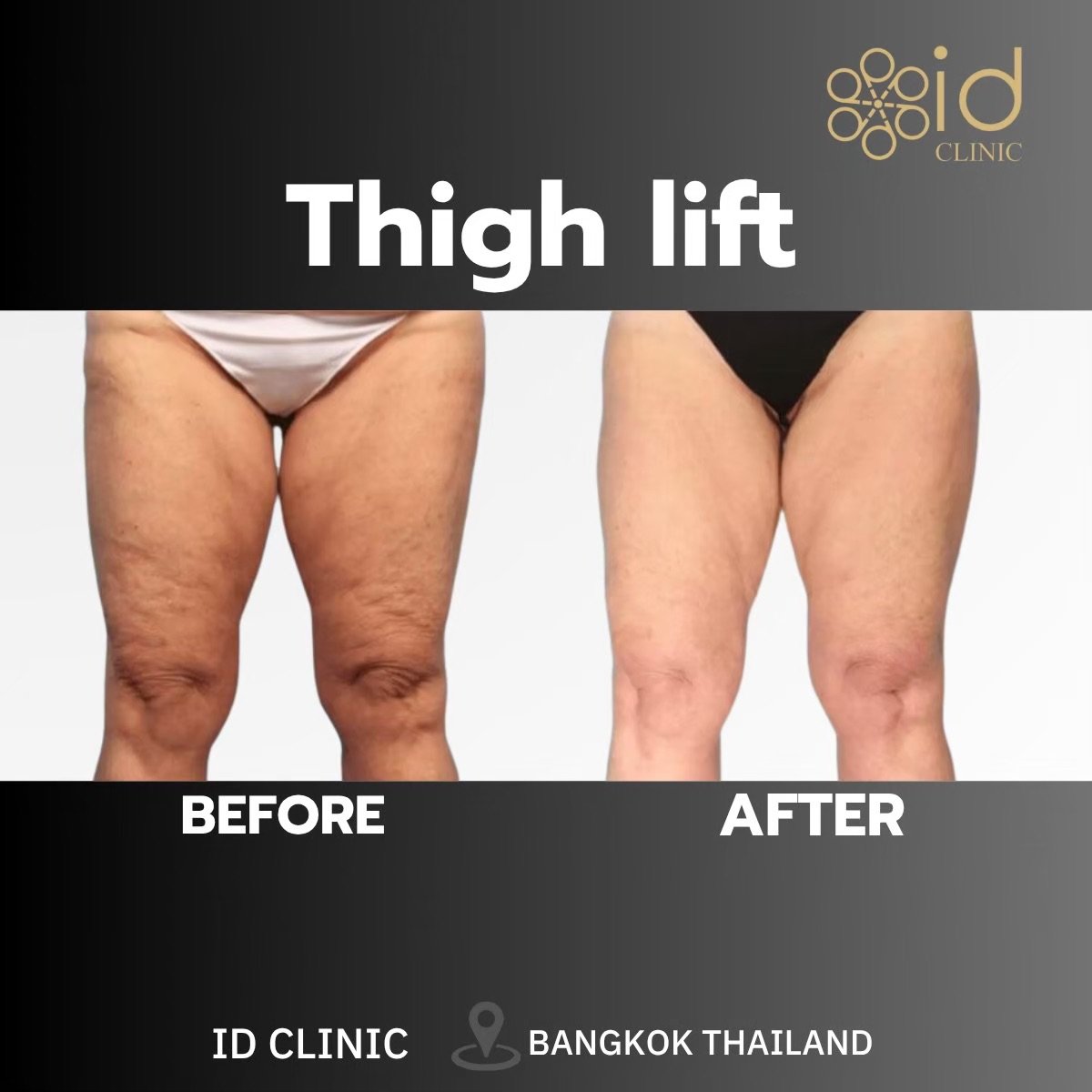 Before and after thigh lift results at ID Clinic Bangkok – smoother, firmer thigh contour