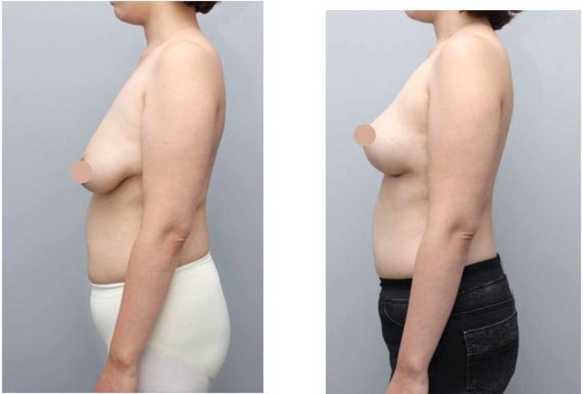 Résultats avant/après lifting mammaire chez AB Plastic Surgery – galbe amélioré des seins