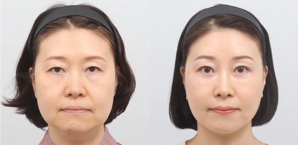 Результаты подтяжки лба до и после в AB Plastic Surgery – гладкий, молодой лоб