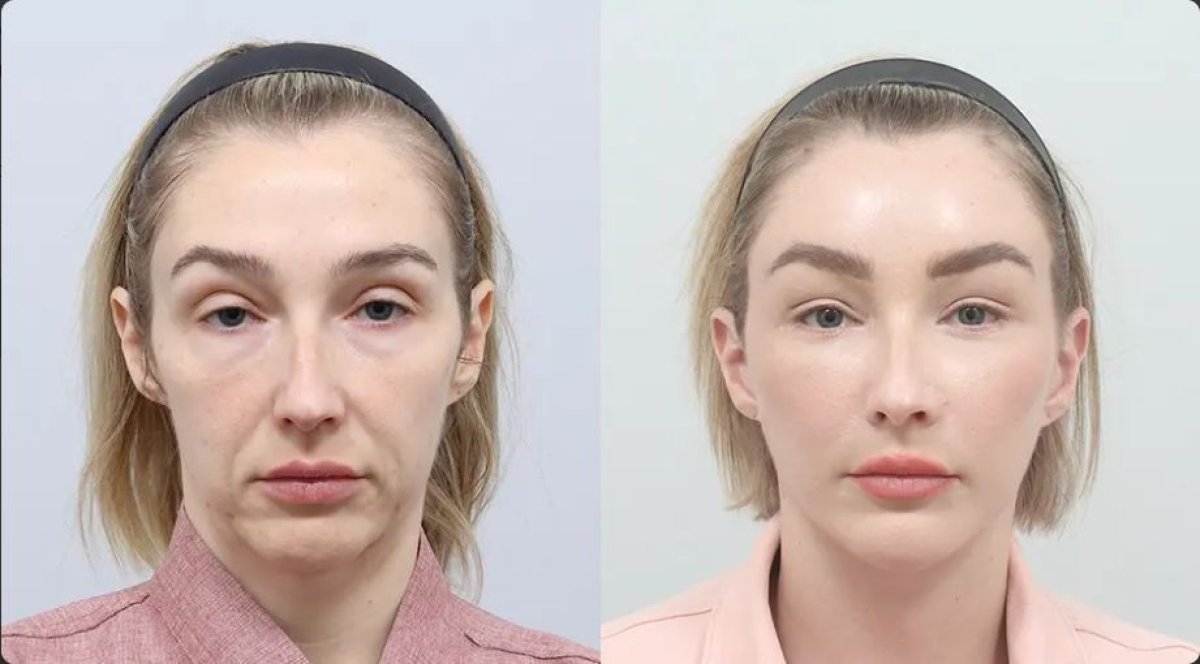 Résultats lifting du front avant/après chez AB Plastic Surgery – front plus lisse et jeune
