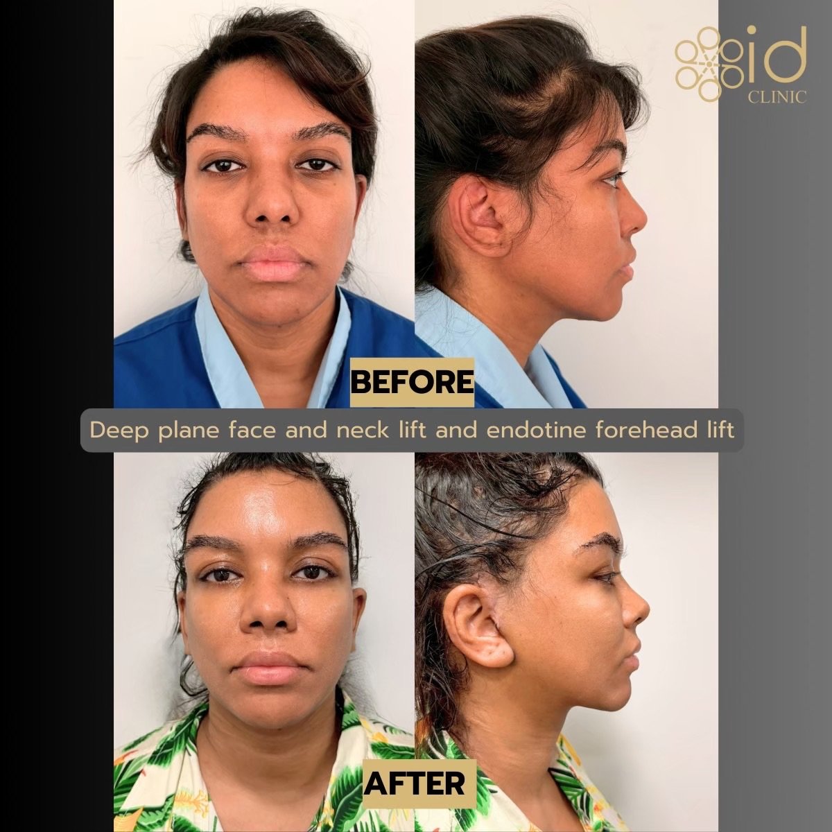 Before and after deep plane face and neck lift with endotine forehead lift at ID Clinic Bangkok