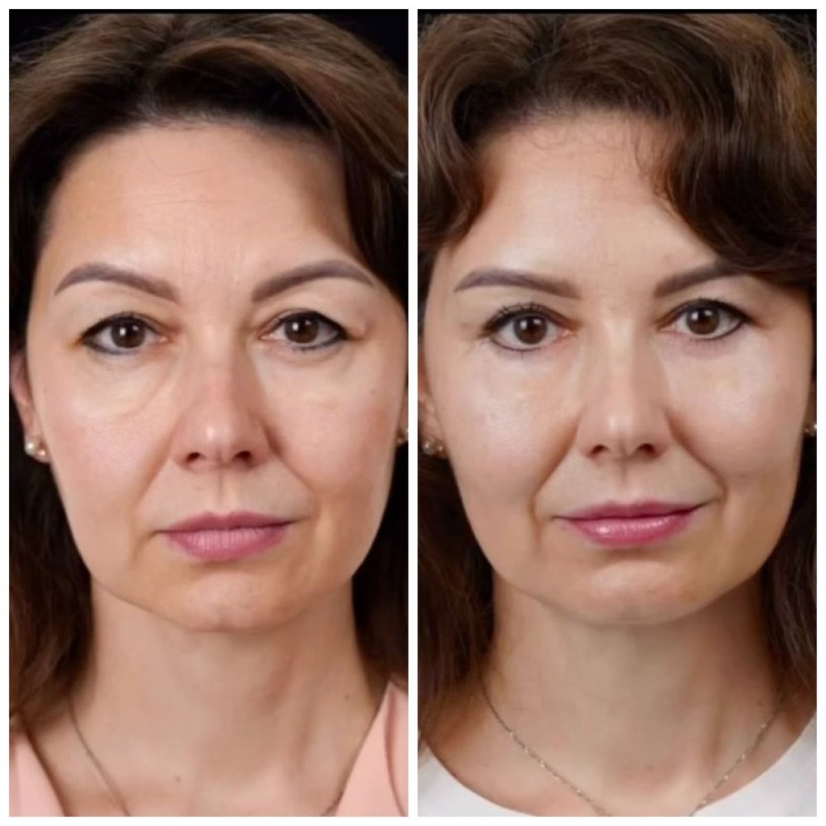 Facelift before and after results at Yurchenko Plastic Surgery Team Kyiv, facial rejuvenation