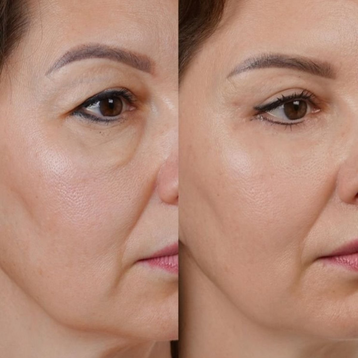 Результаты до и после SMAS-лифтинга в Yurchenko Plastic Surgery Team Kyiv, гладкая кожа