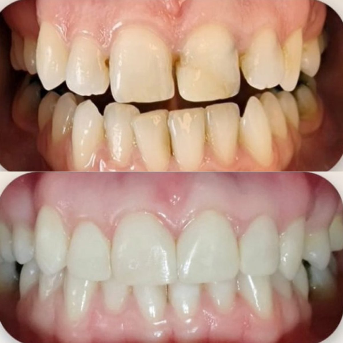 Résultats avant et après bonding dentaire chez Punta cana dentist odontologia familiar, sourire amélioré