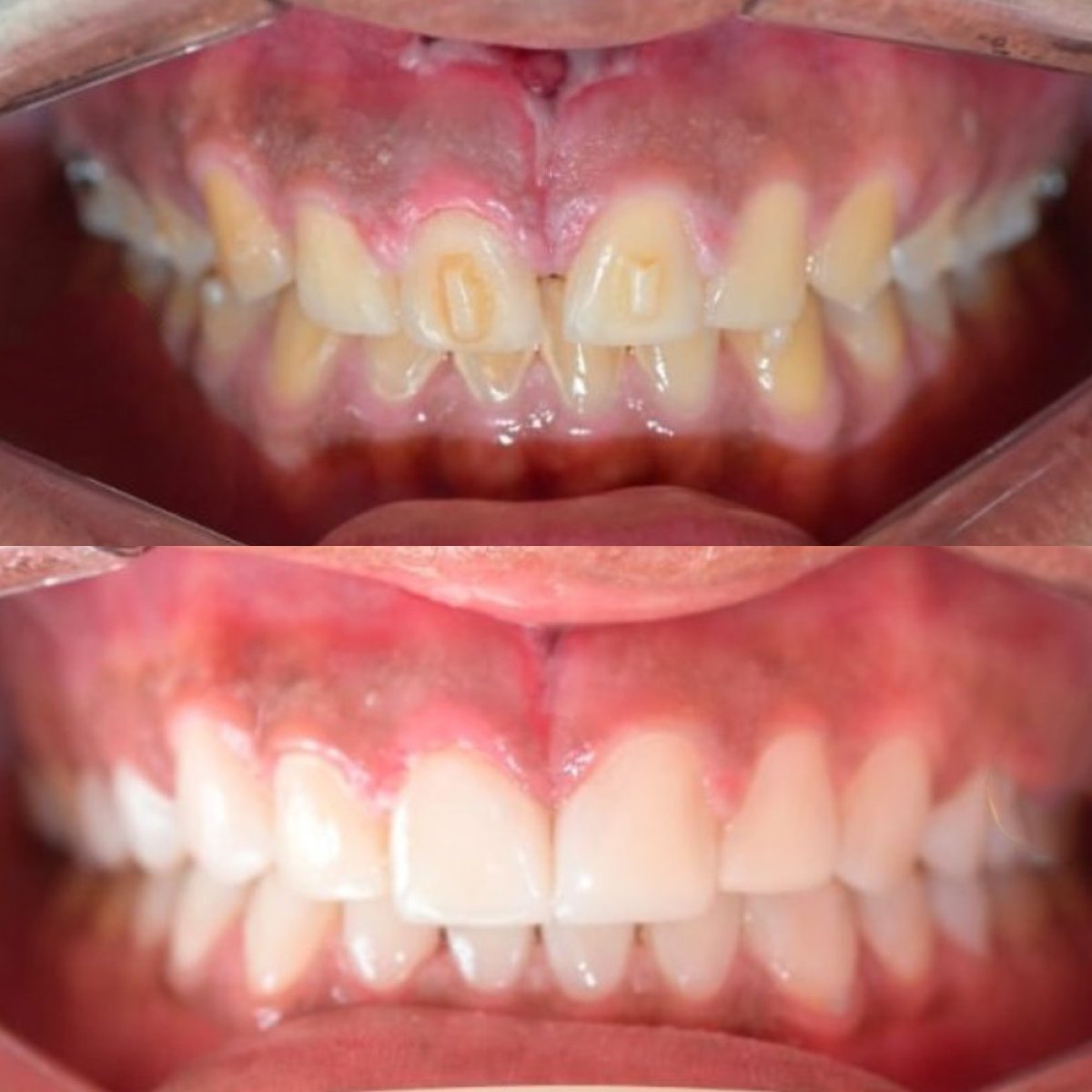 Resultados antes y después de carillas de composite en Punta cana dentist odontologia familiar