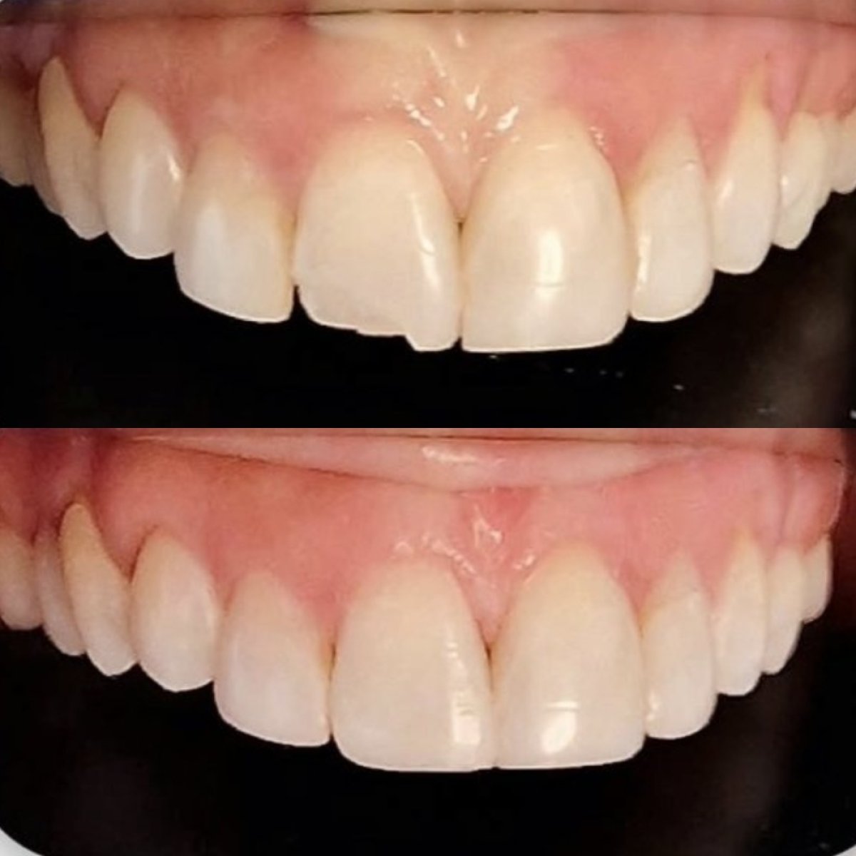 نتيجة قبل وبعد الفينير في Punta cana dentist odontologia familiar، تحسين جمالية الابتسامة