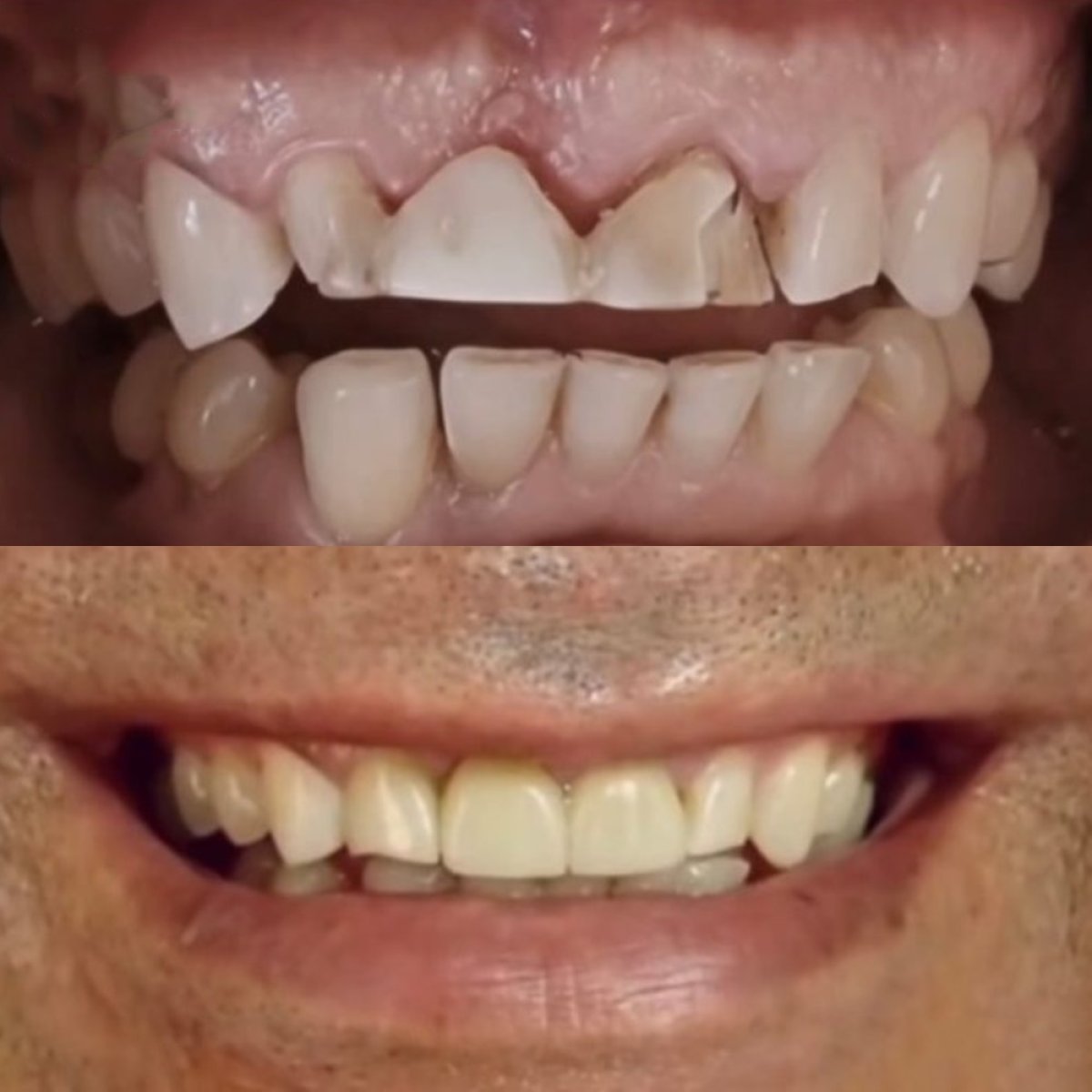 Результат до и после установки циркониевых виниров в Punta cana dentist odontologia familiar