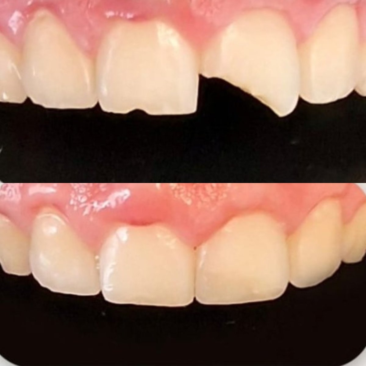 Resultados antes y después de restauración dental con bonding en Punta cana dentist odontologia familiar