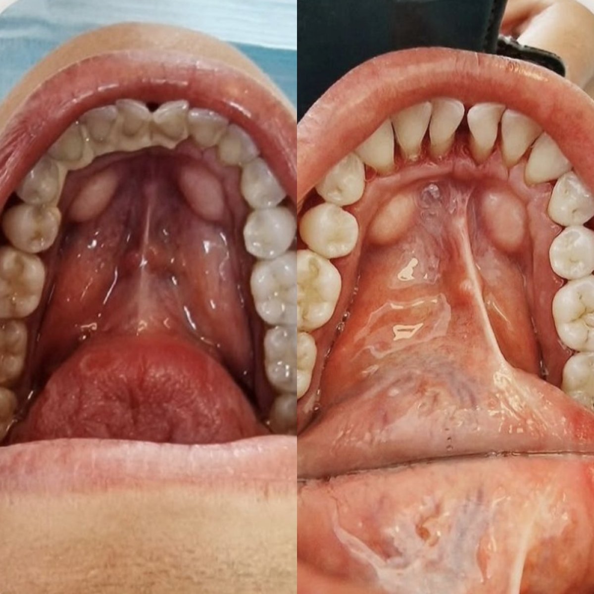 قبل وبعد ترميم الأسنان (تجميل) في Punta cana dentist odontologia familiar، نتيجة محسنة