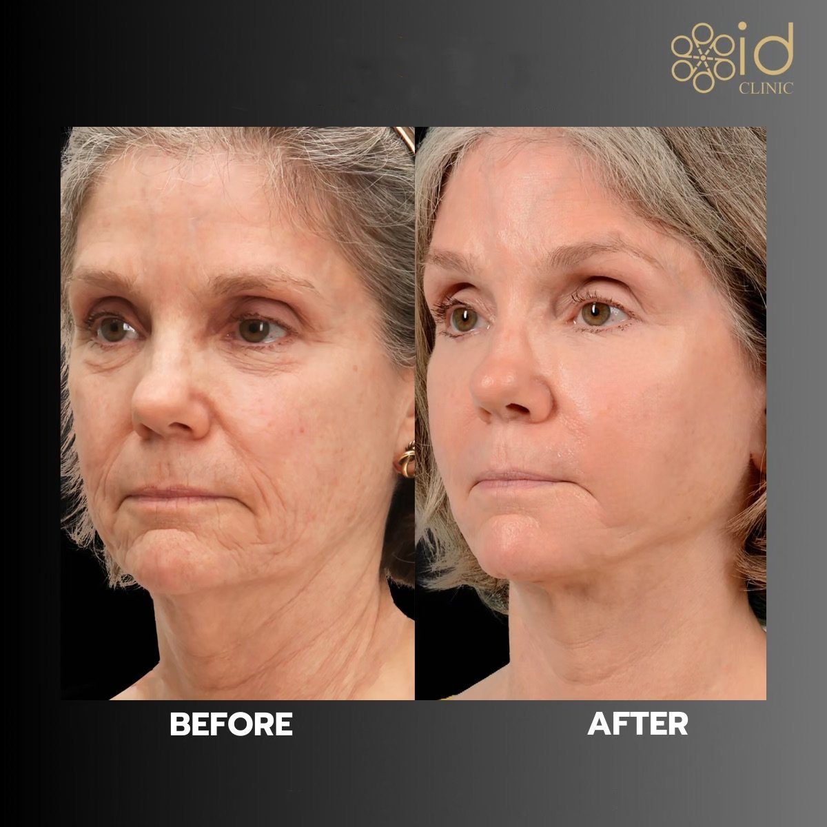 Before and after neck lift results at ID Clinic Bangkok, visible skin tightening and rejuvenation