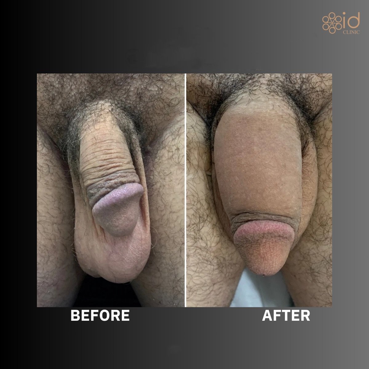 Before and after surgical penile lengthening results at ID Clinic Bangkok, visible size increase