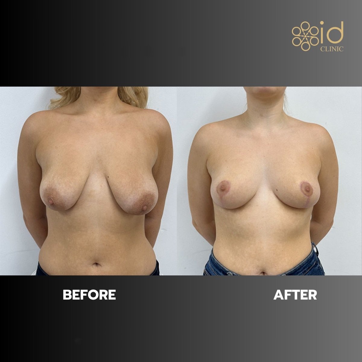 Before and after breast lift results at ID Clinic Bangkok, improved breast shape and contour