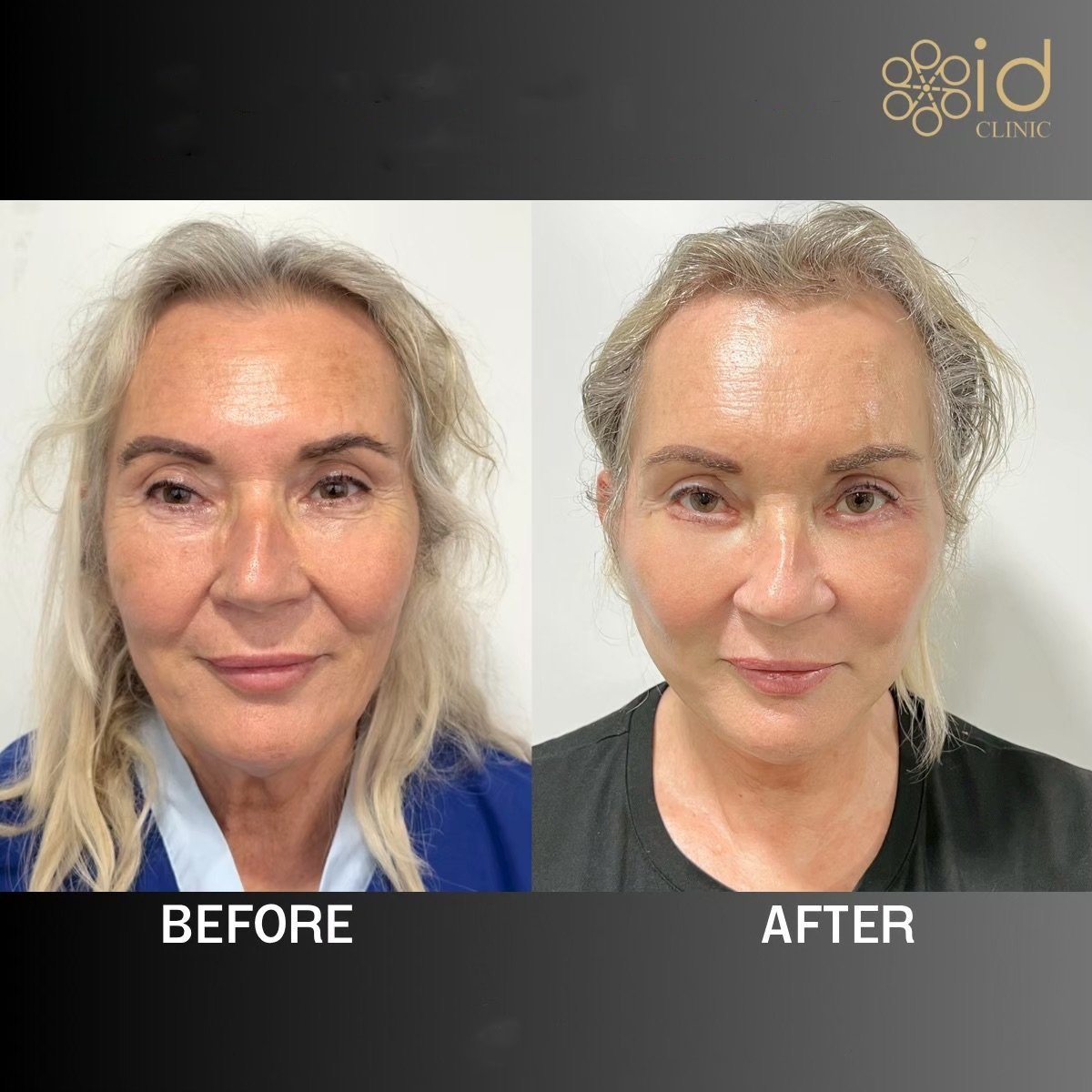 Before and after forehead lift results at ID Clinic Bangkok, visible smoother forehead and brows