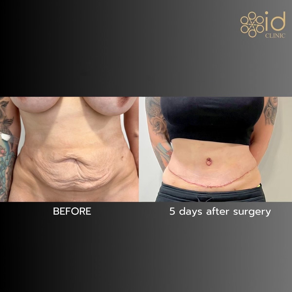 Before and after tummy tuck and liposuction results at ID Clinic Bangkok, flatter abdomen