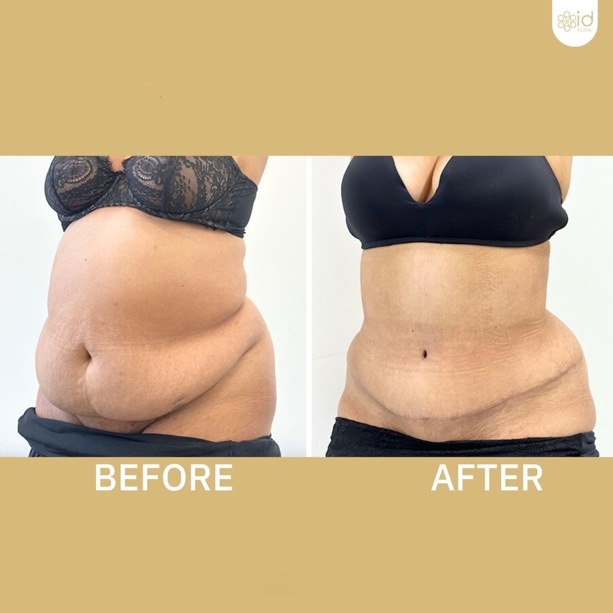 Before and after tummy tuck and liposuction results at ID Clinic Bangkok, flatter abdomen