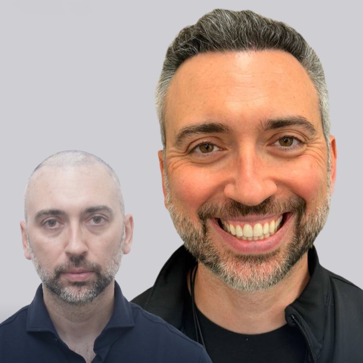 Before and after FUE hair transplant results in male patient – restored fuller hairline