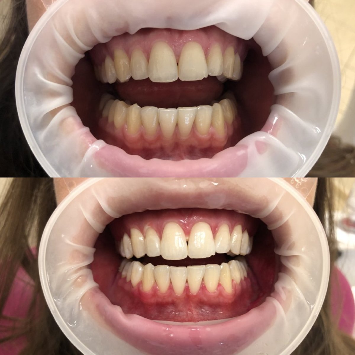 Результати до і після відбілювання зубів у Dentium Implant Center, помітно біліша усмішка