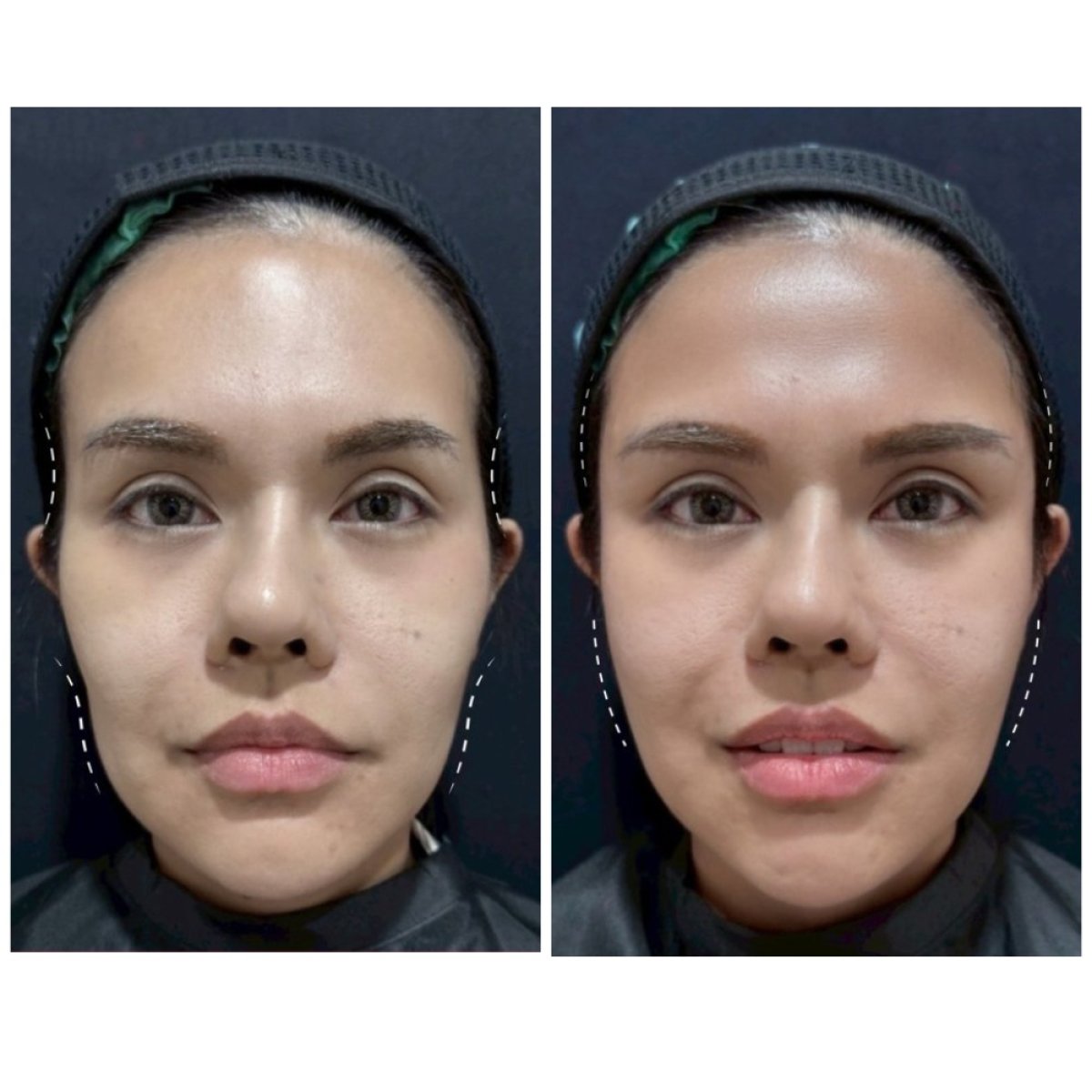 Before and after fillers injection result at Somchai Clinic, enhanced facial contour and volume