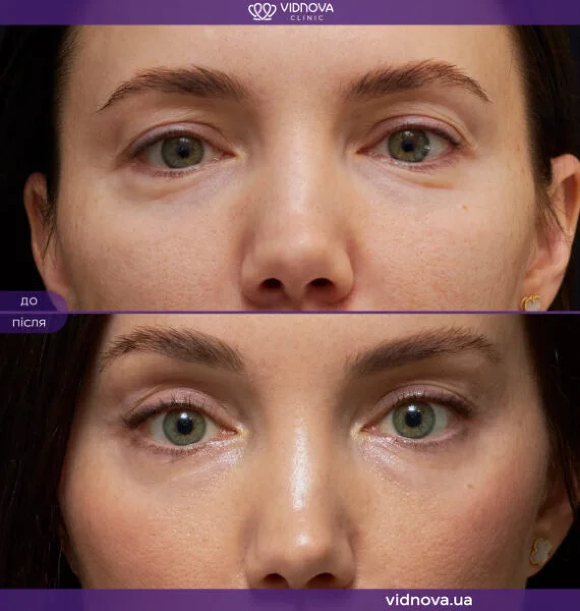 Resultados de lifting de cejas antes y después en Vidnova Clinic – rejuvenecimiento ocular