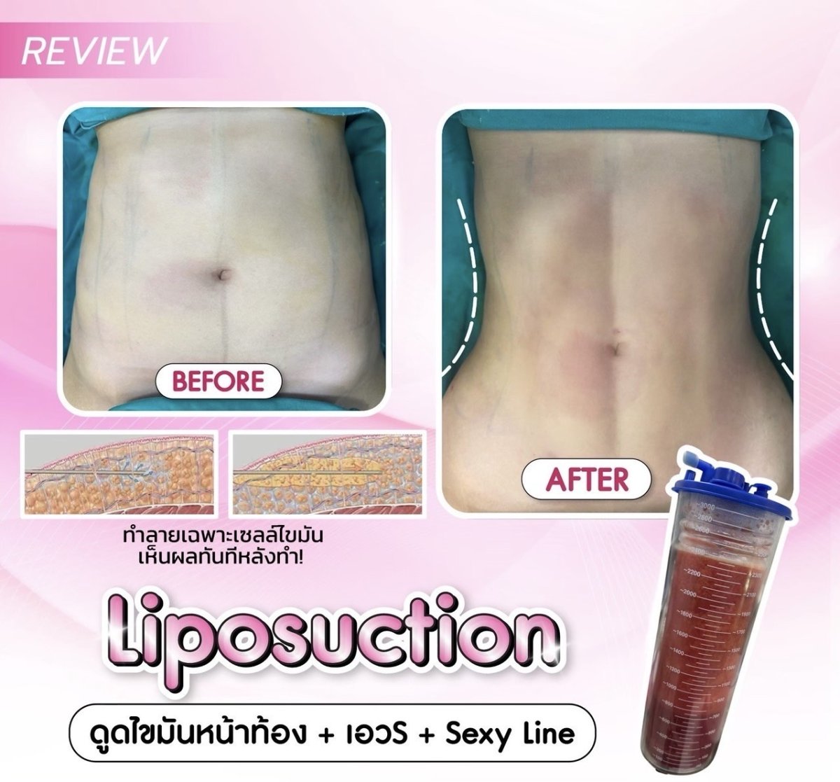 Before and after liposuction results at Somchai Clinic – flatter, contoured abdomen visible