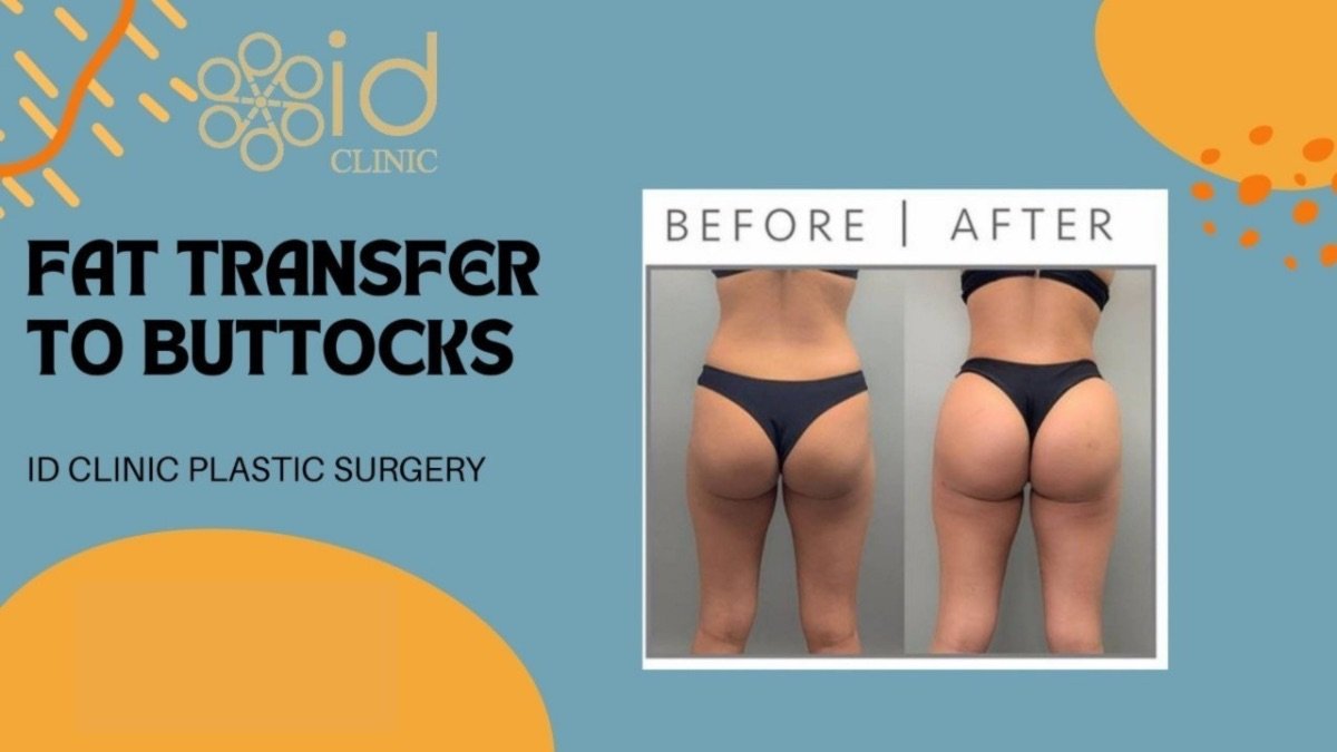 Before and after fat transfer to buttocks at ID Clinic Bangkok, visible volume enhancement result