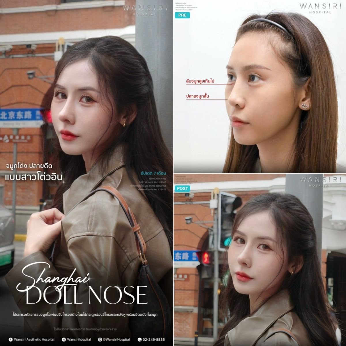 Before and after rhinoplasty results at Wansiri Hospital, Shanghai Doll Nose procedure