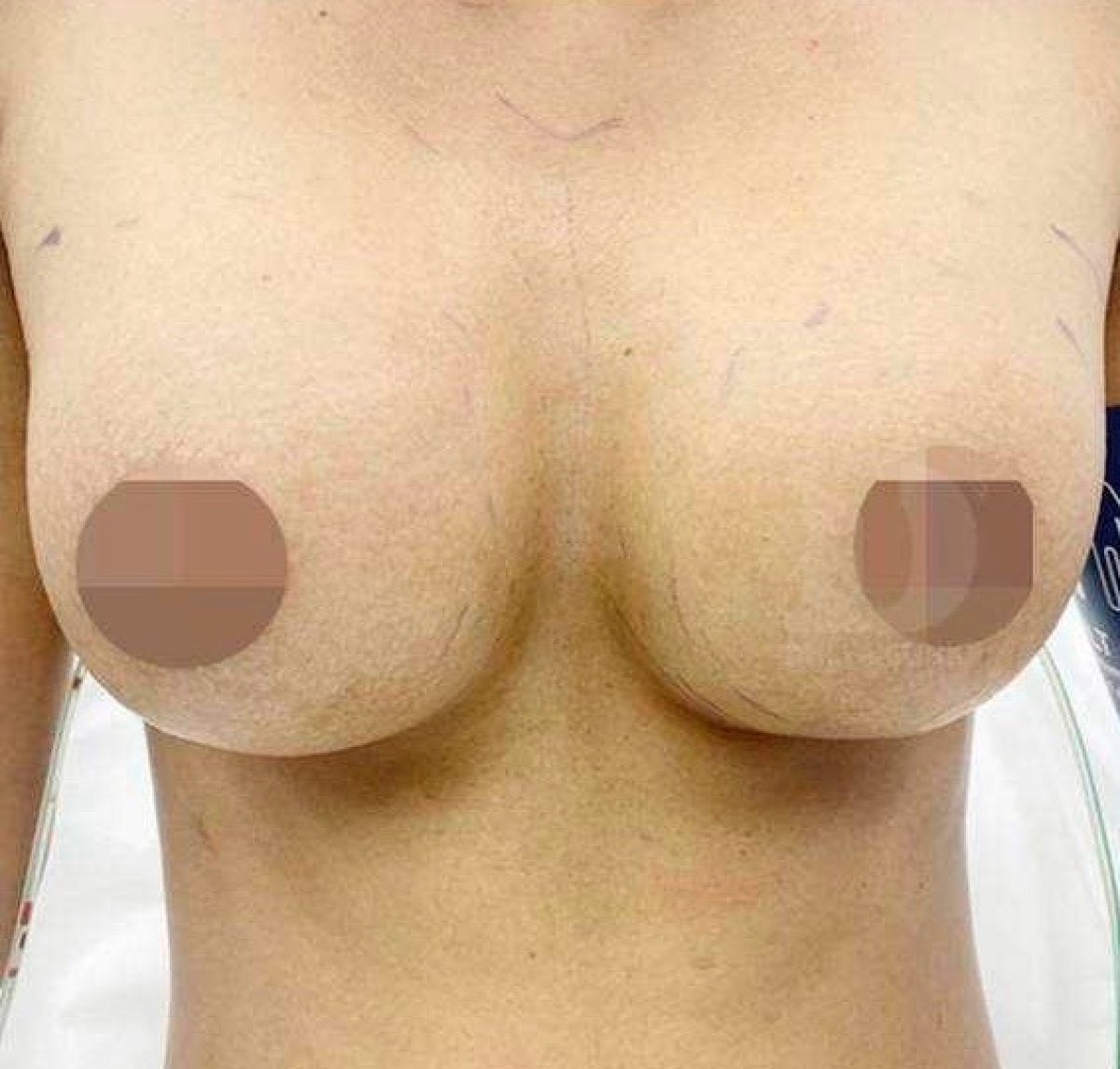 Résultat d’augmentation mammaire – seins plus volumineux et naturels après la procédure