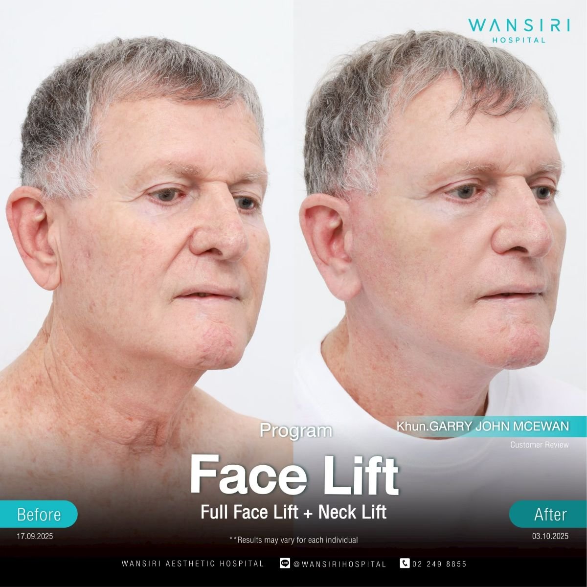 Before and after facelift and neck lift results at Wansiri Hospital, visible facial rejuvenation