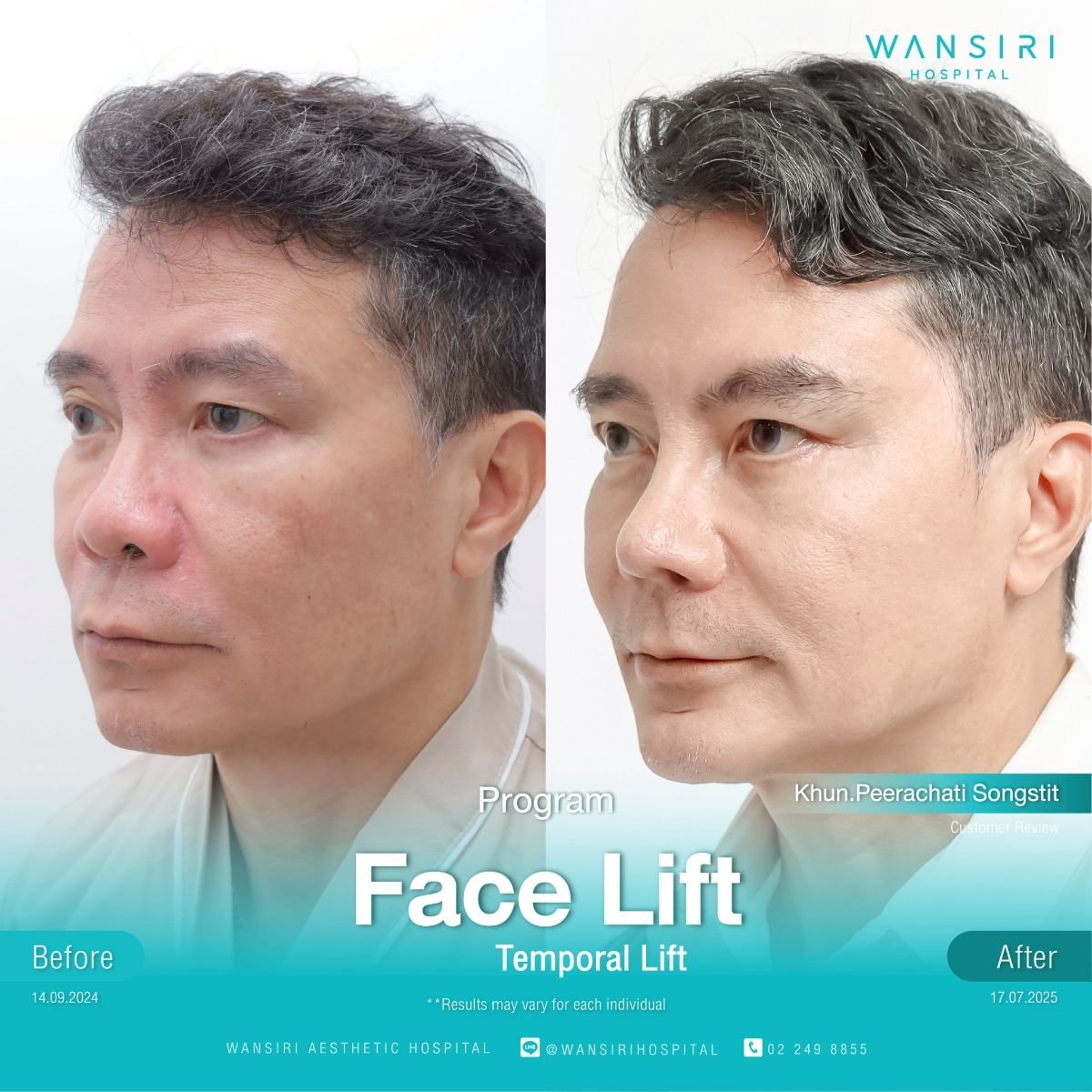 Before and after facelift results at Wansiri Hospital, temporal lift for facial rejuvenation