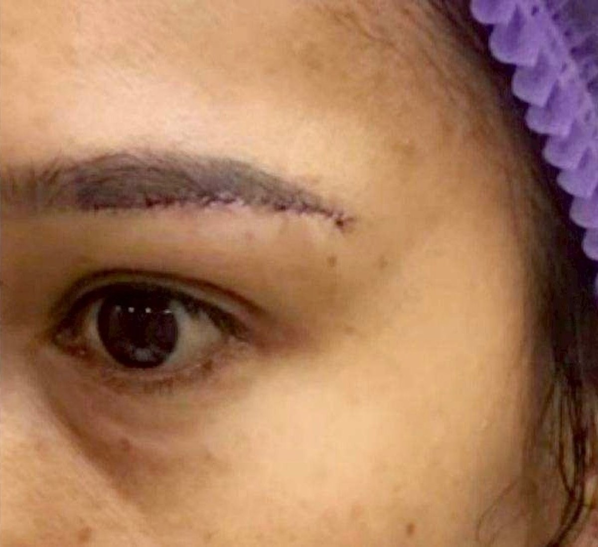 Blepharoplasty result showing upper eyelid correction and healing incision after surgery