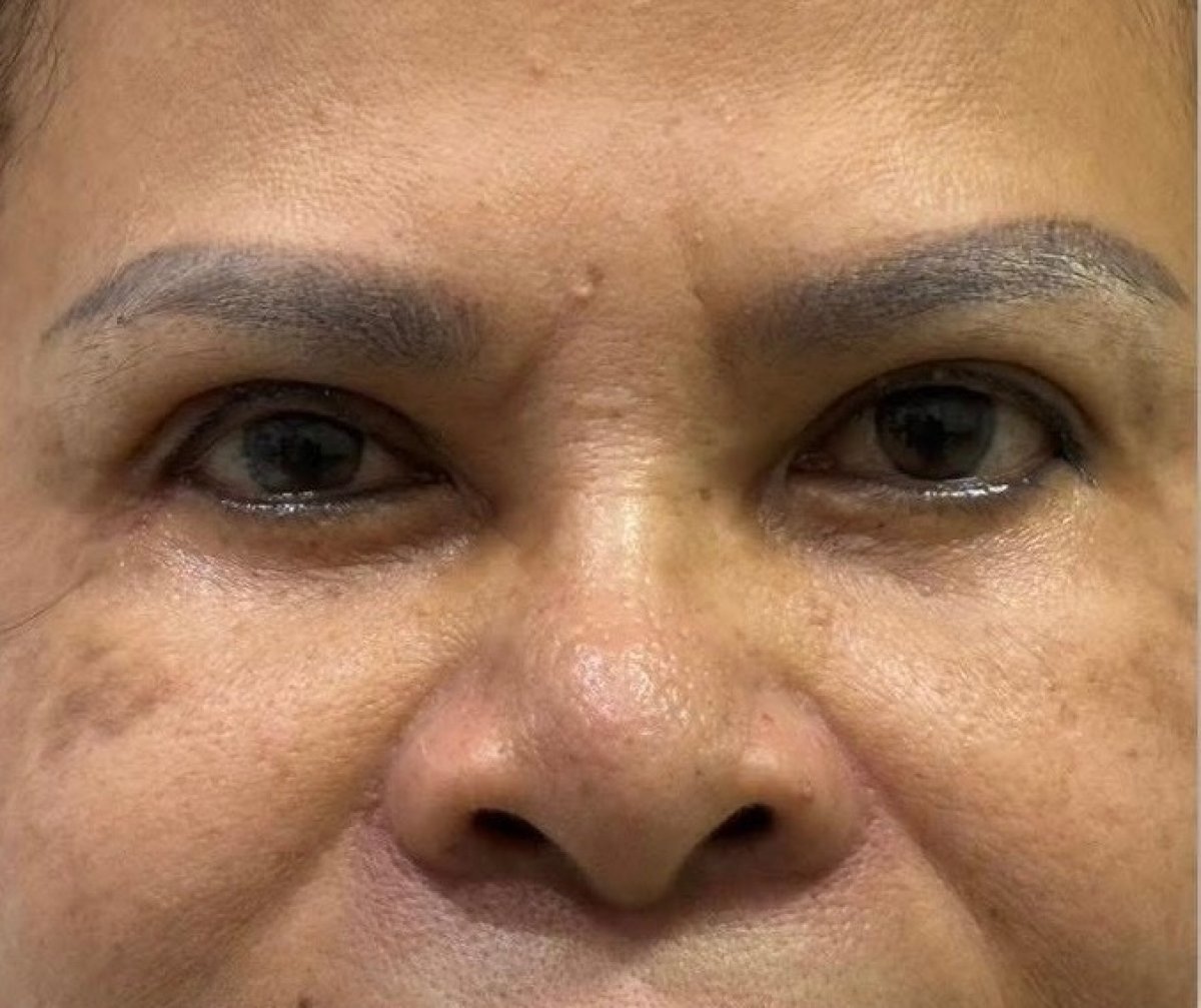 Blepharoplasty result – improved upper and lower eyelid appearance after eyelid surgery