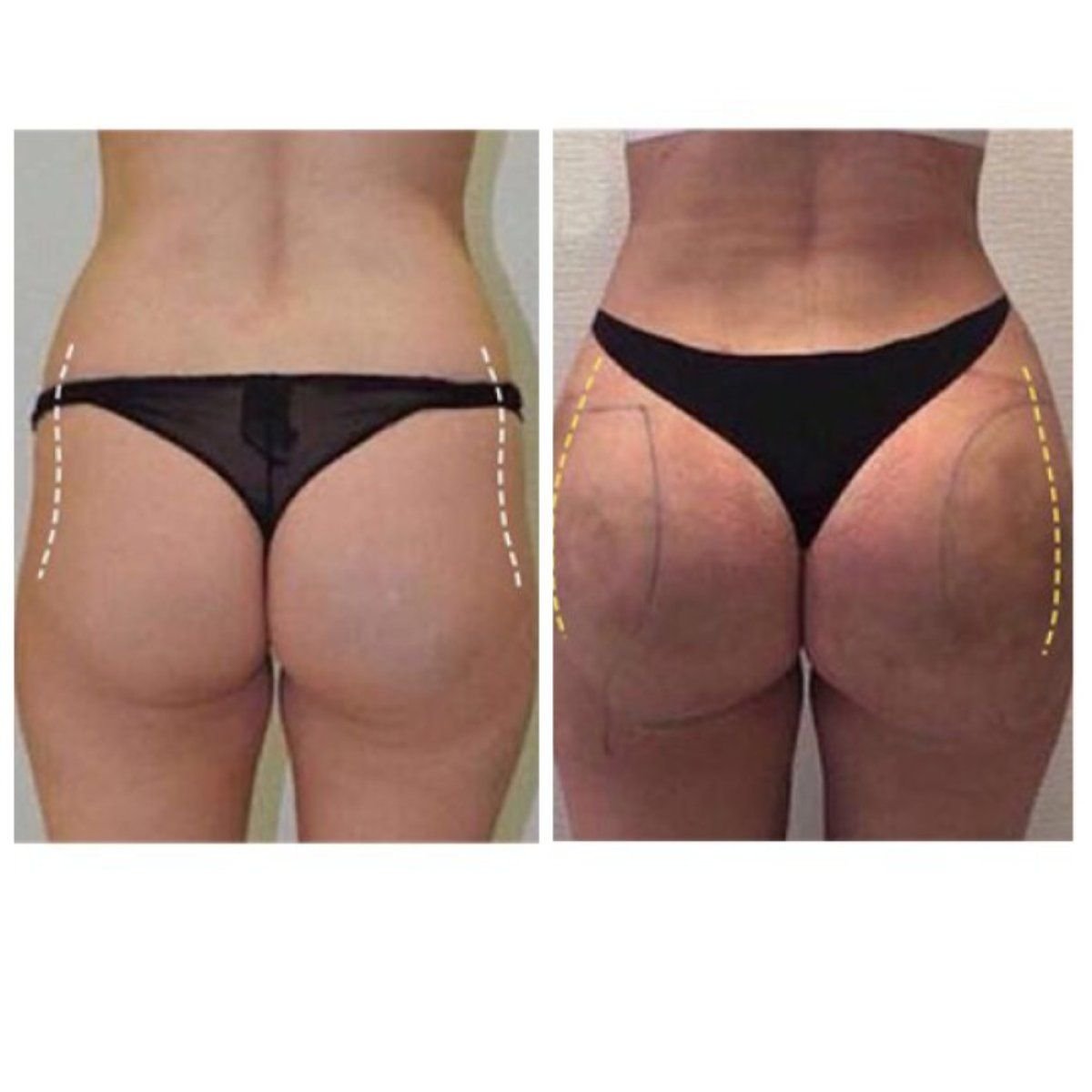 Résultats avant et après Brazilian Butt Lift à Klinika La Perla, galbe des fesses amélioré