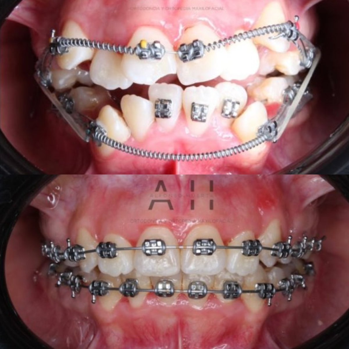 Efekty przed i po aparacie ortodontycznym w CIVICO DENTAL CARE MEXICALI, poprawa ustawienia zębów