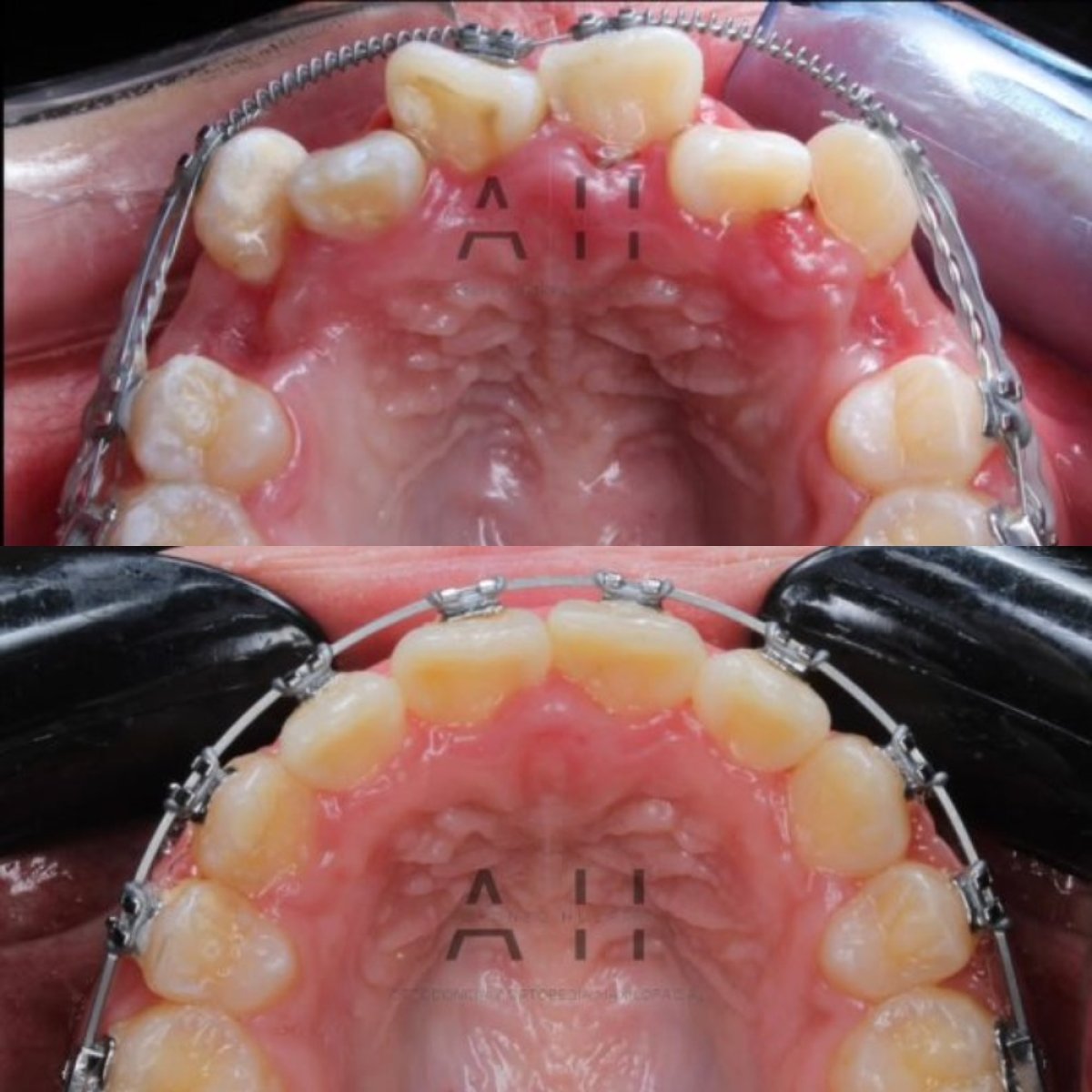 Efekty przed i po aparacie ortodontycznym w CIVICO DENTAL CARE MEXICALI, poprawa ustawienia zębów