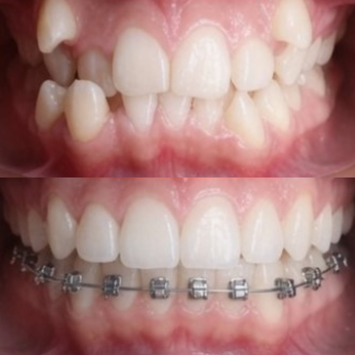 Resultados antes y después de brackets en CIVICO DENTAL CARE MEXICALI, mejora de alineación dental