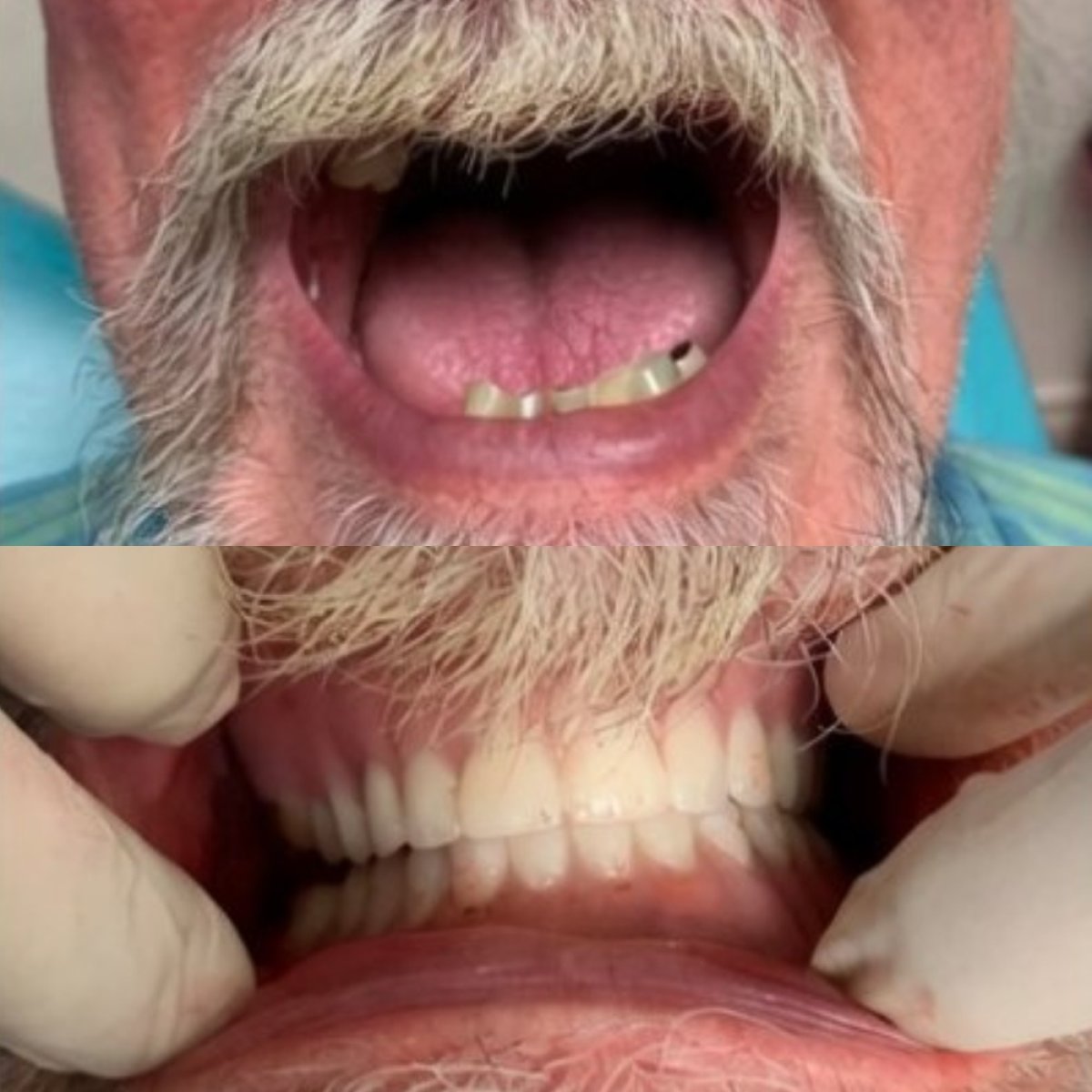 До та після імплантації зубів у CIVICO DENTAL CARE MEXICALI, відновлена посмішка