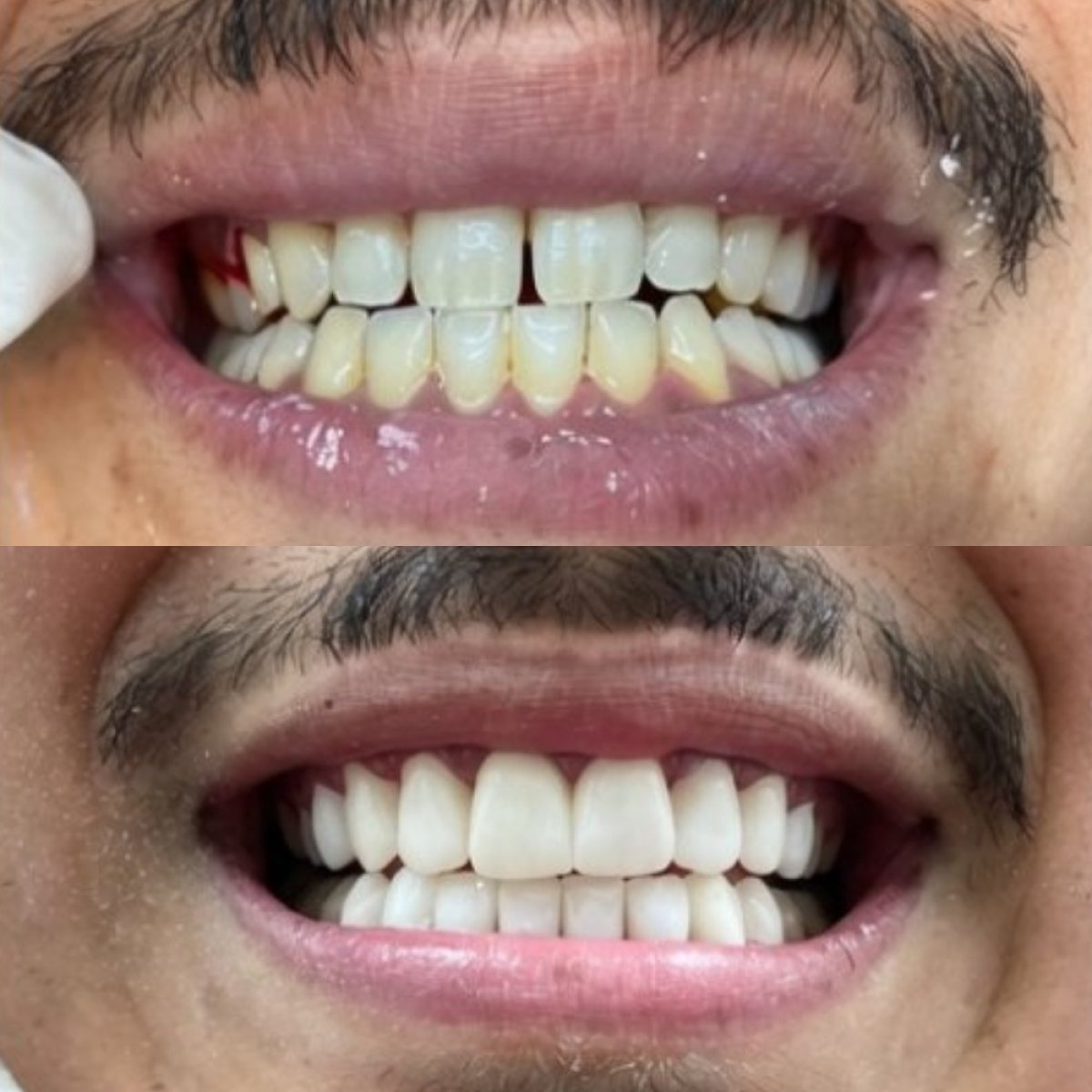 Hollywood Smile before and after results at CIVICO DENTAL CARE MEXICALI, smile makeover