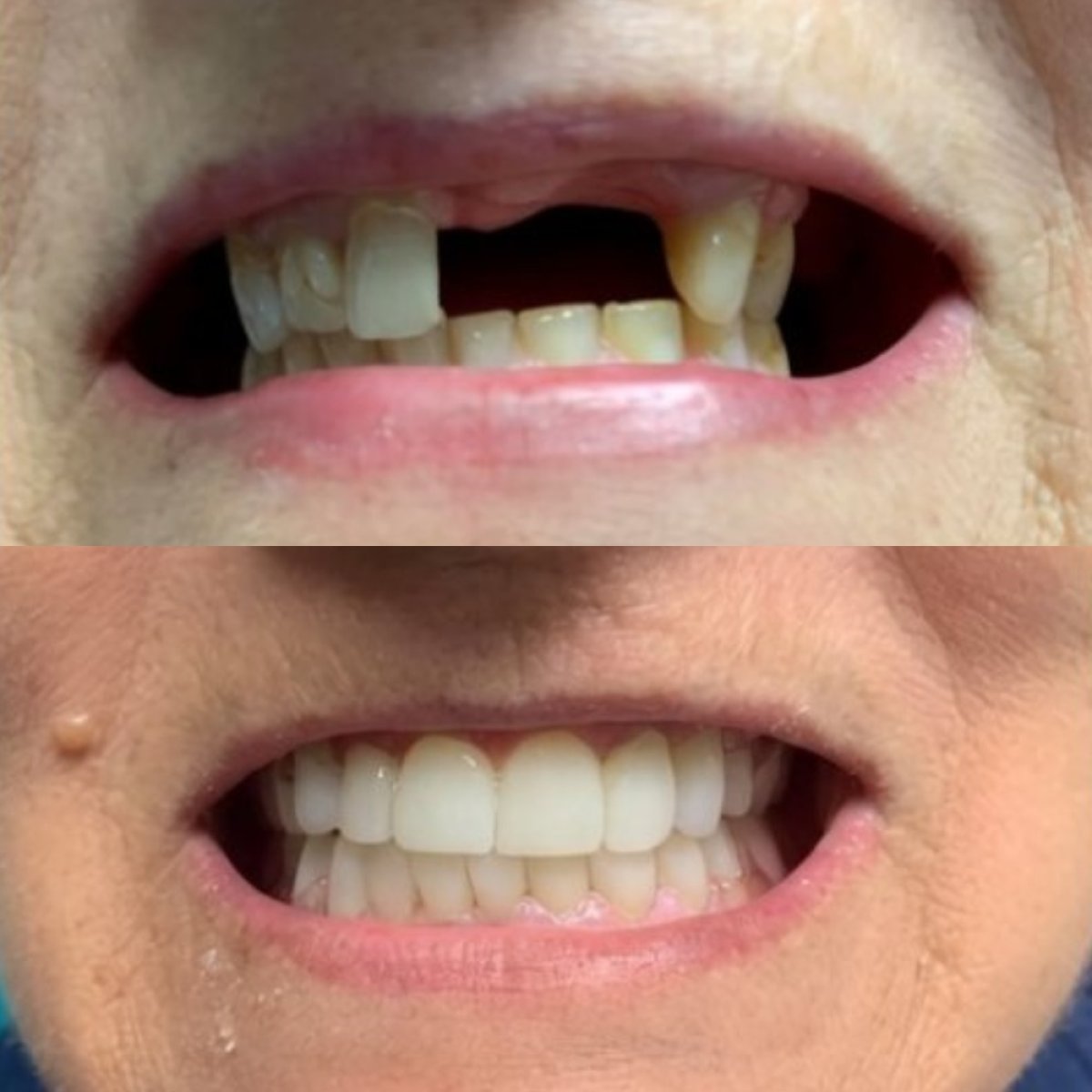 Before and after Hollywood Smile dental restoration at CIVICO DENTAL CARE MEXICALI, visible result